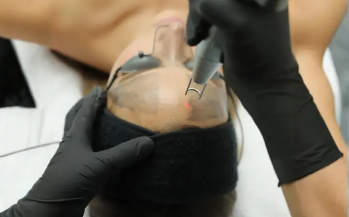 Close-up of a Pico Laser session at The Wellness Ed — a clinician in black medical gloves carefully positions a precision laser handpiece above a guest's cheek, the visible red aiming dot landing exactly on the targeted pigmentation while soft black protective eye shields keep her safe under the warm clinic lighting.