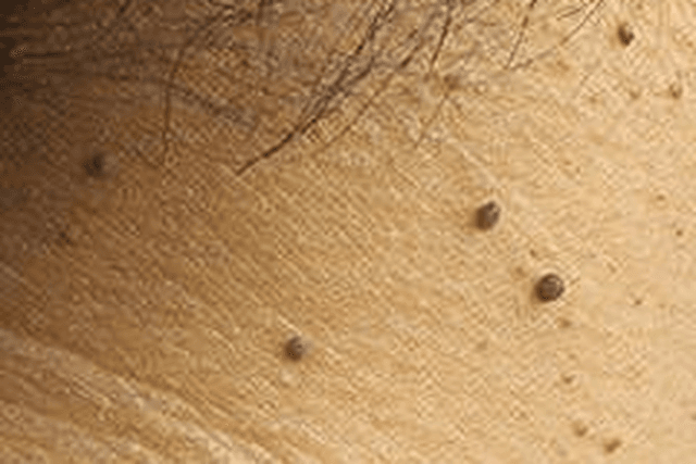 Close-up of clustered skin tags on the neck and underarm area — the kind of soft, benign growths gently cleared during a Laser Tag Removal session at The Wellness Ed.