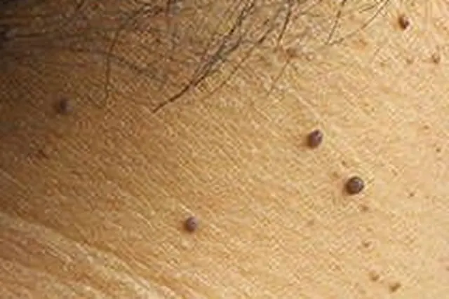 Close-up of clustered skin tags on the neck and underarm area — the kind of soft, benign growths gently cleared during a Laser Tag Removal session at The Wellness Ed.