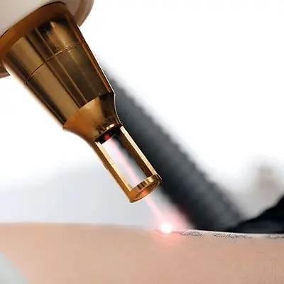 Precision laser handpiece firing a focused pulse onto an existing tattoo during a Laser Tattoo Removal session at The Wellness Ed.