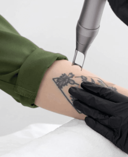 A clinician in black gloves precisely guiding a Q-switched laser handpiece over a forearm tattoo during a tattoo removal session at The Wellness Ed Signature Studio.