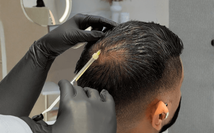 Overhead view of a GFC for Hair session at The Wellness Ed — a clinician in black medical gloves precisely delivers a fine micro-injection of pale-amber growth-factor concentrate into a male guest's scalp along the crown, the calm, doctor-led technique characteristic of an in-clinic regenerative therapy.