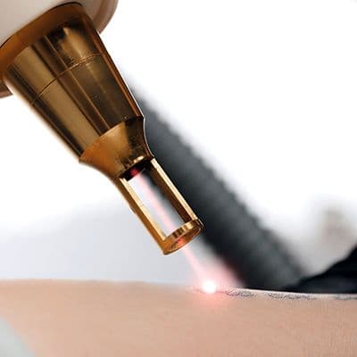 Precision laser handpiece firing a focused pulse onto an existing tattoo during a Laser Tattoo Removal session at The Wellness Ed.