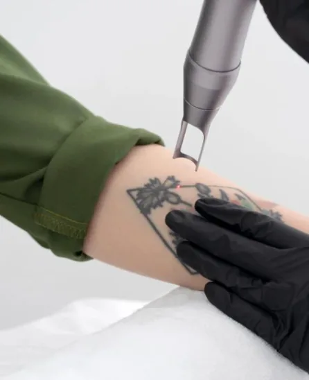 A clinician in black gloves precisely guiding a Q-switched laser handpiece over a forearm tattoo during a tattoo removal session at The Wellness Ed Signature Studio.